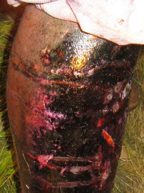 Gangrenous leg